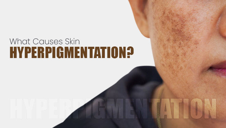 What Causes Skin Hyperpigmentation?