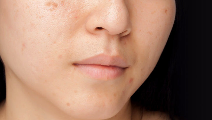 What Are Age Spots? Turn to Smart Aging Skin Care Routine?